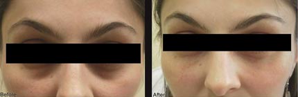Tratamente naturale pentru cearcăne și cercurile negre de sub ochi - Frumuseţe > Cosmetica - urgente-instalatori.ro